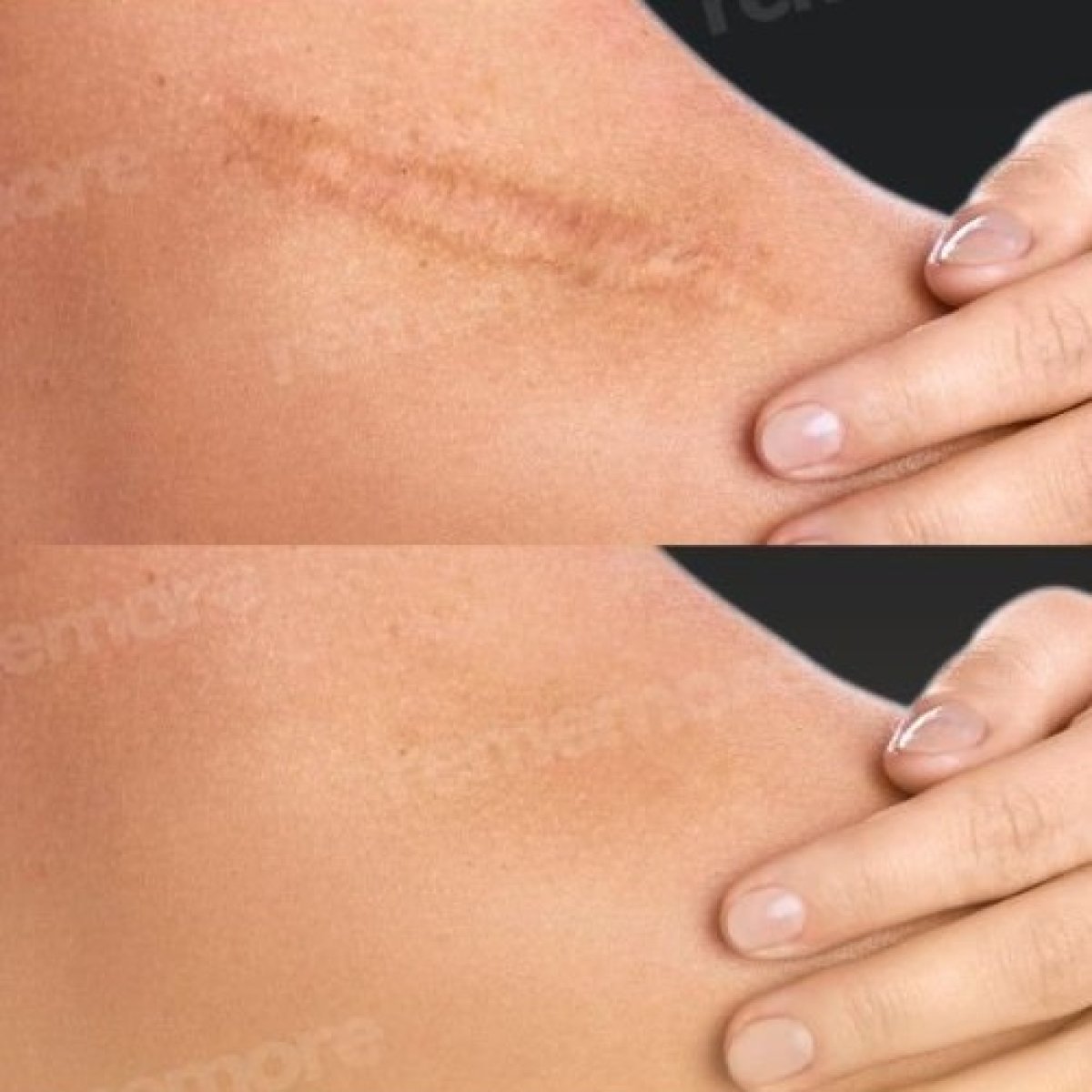 Scar revision before and after results at Memorial Şişli Hospital, improved skin appearance