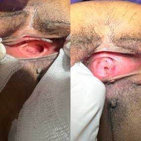 Premium Hymenoplasty (hymen restoration) 1 night hotel stay, transfers included.