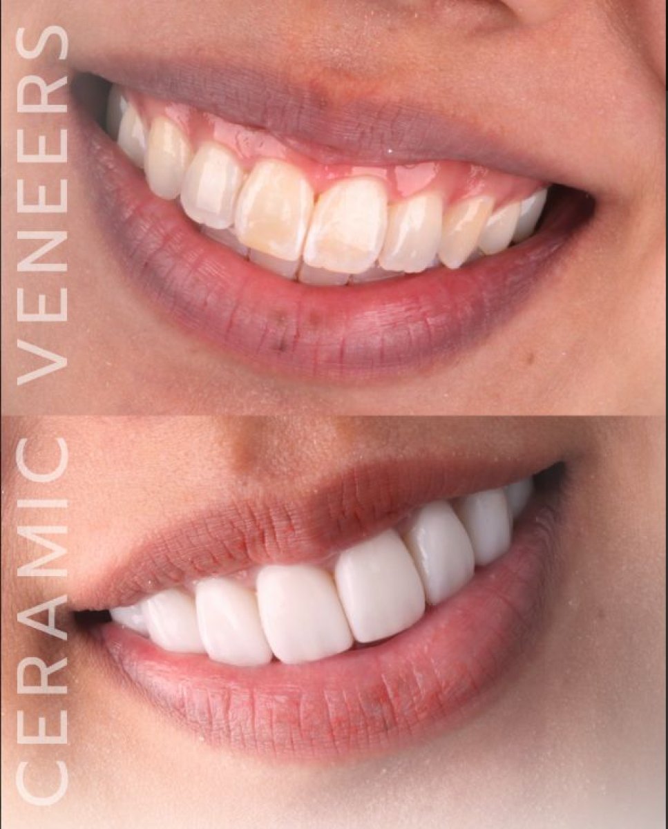 نتيجة قبل وبعد الفينير الخزفي في SmileBox Dental Clinic - Thonglor, Sukhumvit Branch