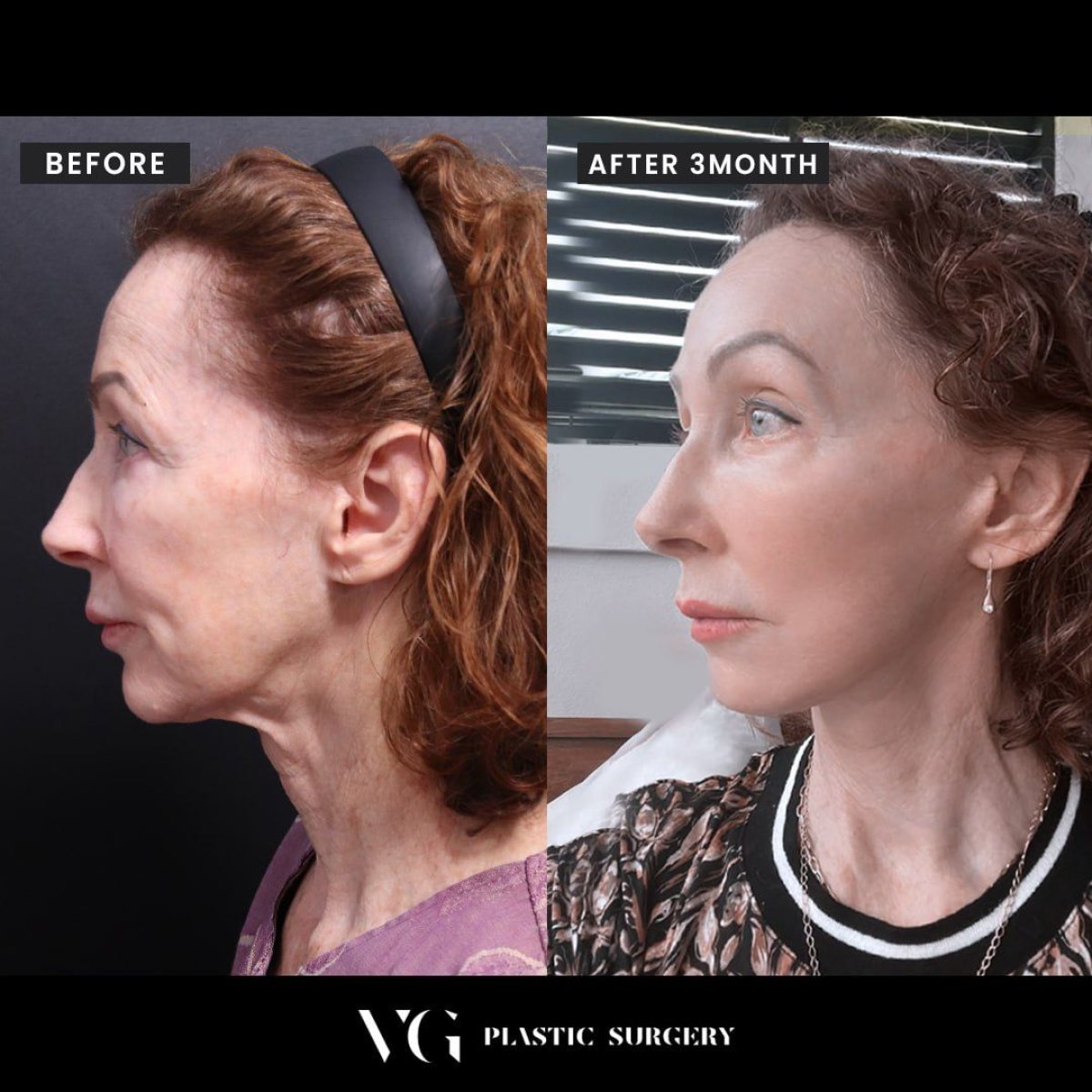 نتائج شد الوجه بالمنظار قبل وبعد في VG Plastic Surgery، تجديد شباب الوجه