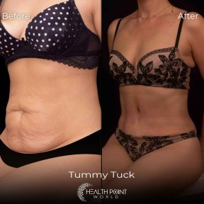 Vaser Liposuction 2-3 zones - photo 3