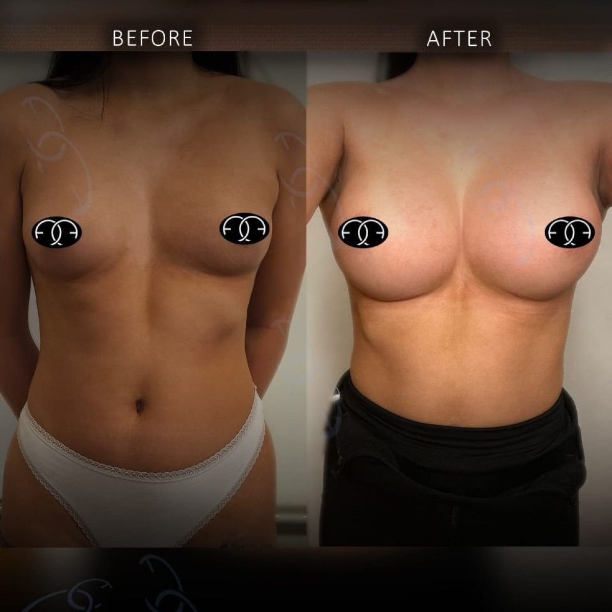 Vorher-nachher-Ergebnis Brustvergrößerung bei Dr. Safa Manav Clinic, vollere Brustform