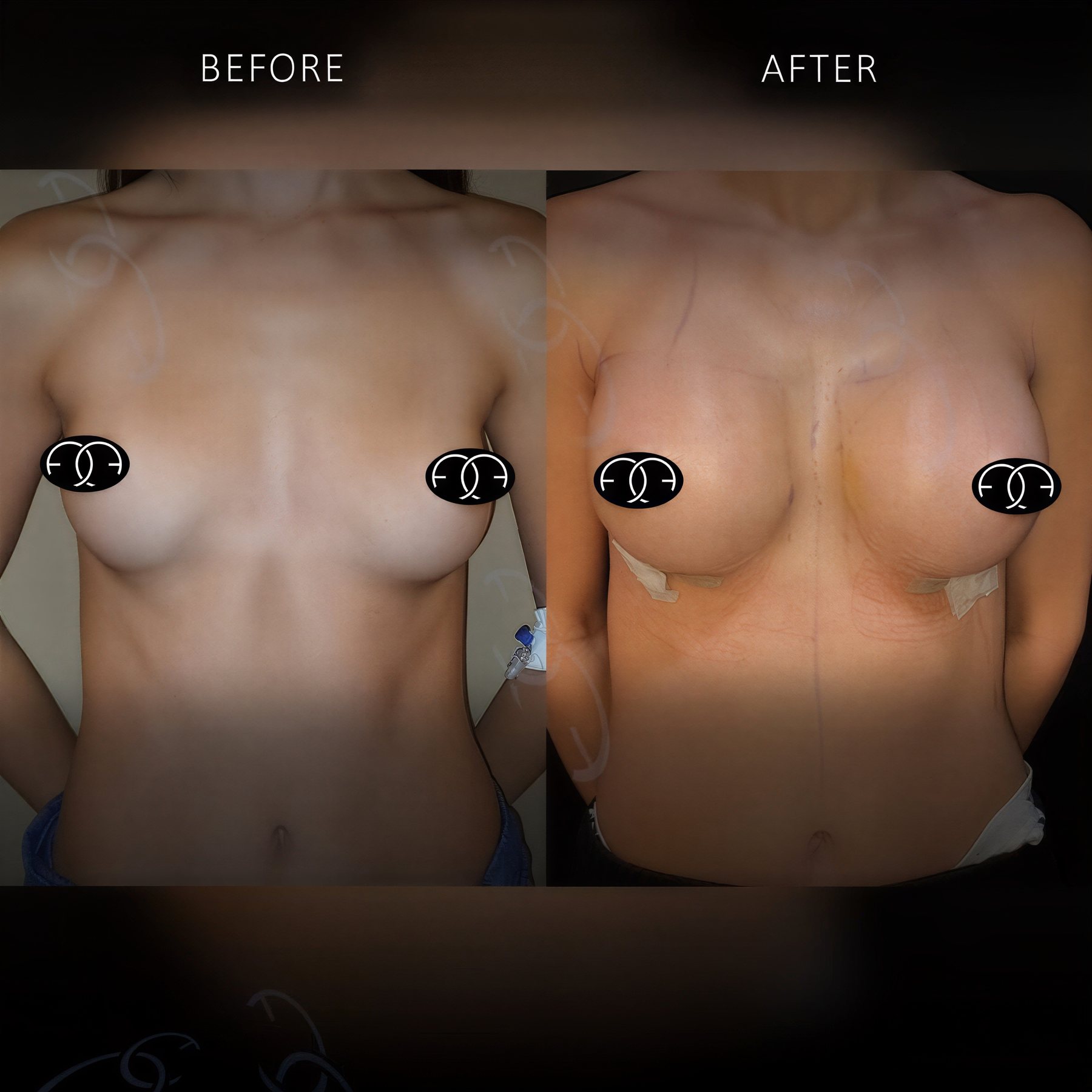 Before and after breast augmentation results at Dr. Safa Manav Clinic, enhanced breast size