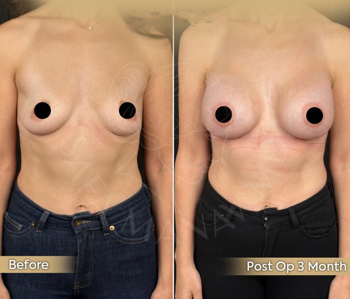 Before and after breast augmentation results at Dr. Safa Manav Clinic, 3 months post-op