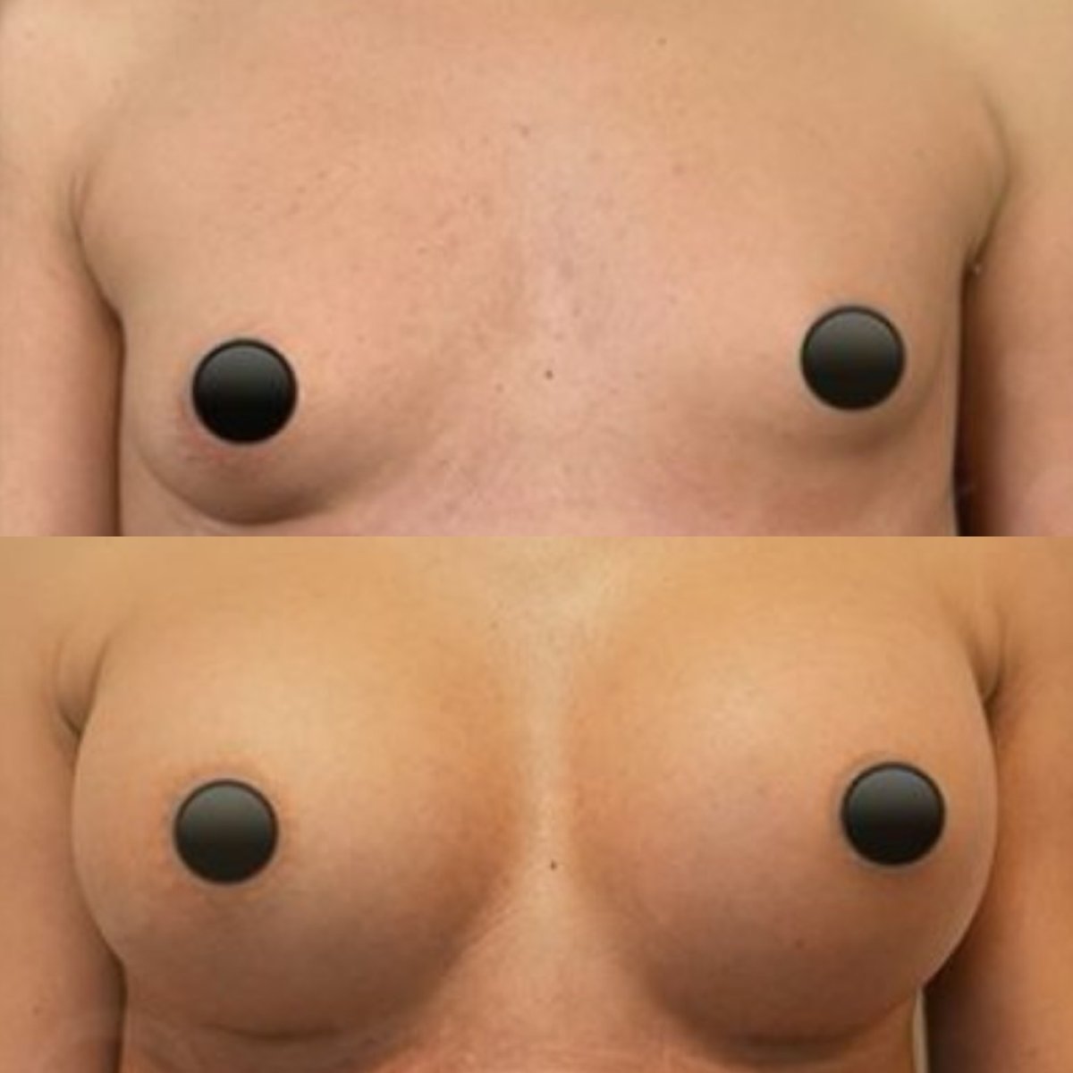 Before and after breast augmentation with fat transfer at Dr. Safa Manav Clinic, visible results