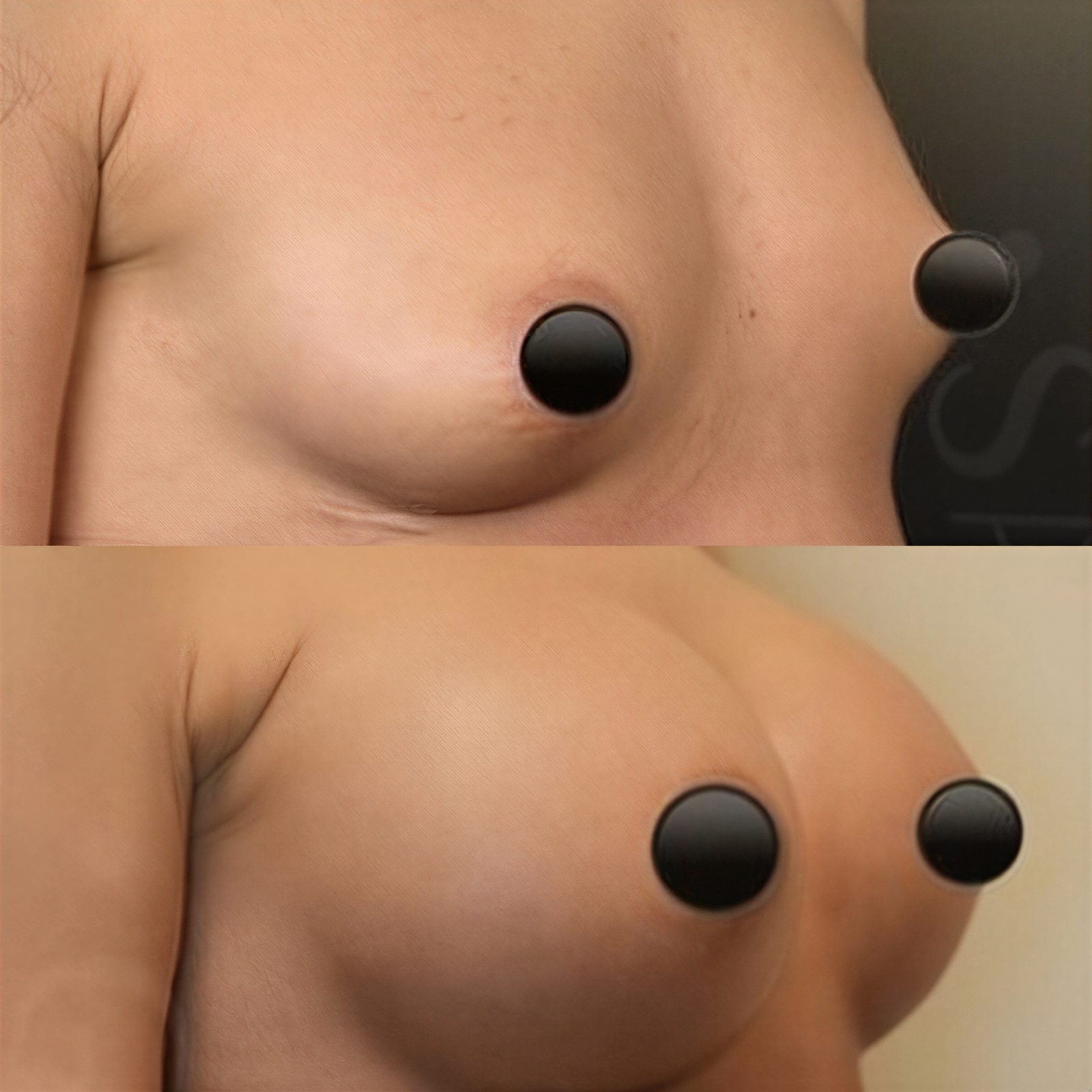 Antes y después de aumento de senos con transferencia de grasa en Dr. Safa Manav Clinic