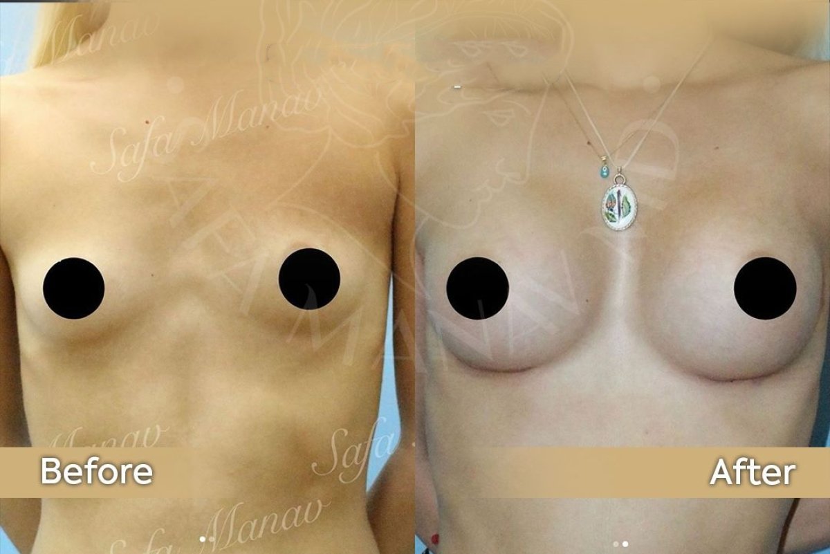 Resultados antes y después de aumento de senos con lipofilling en Dr. Safa Manav Clinic