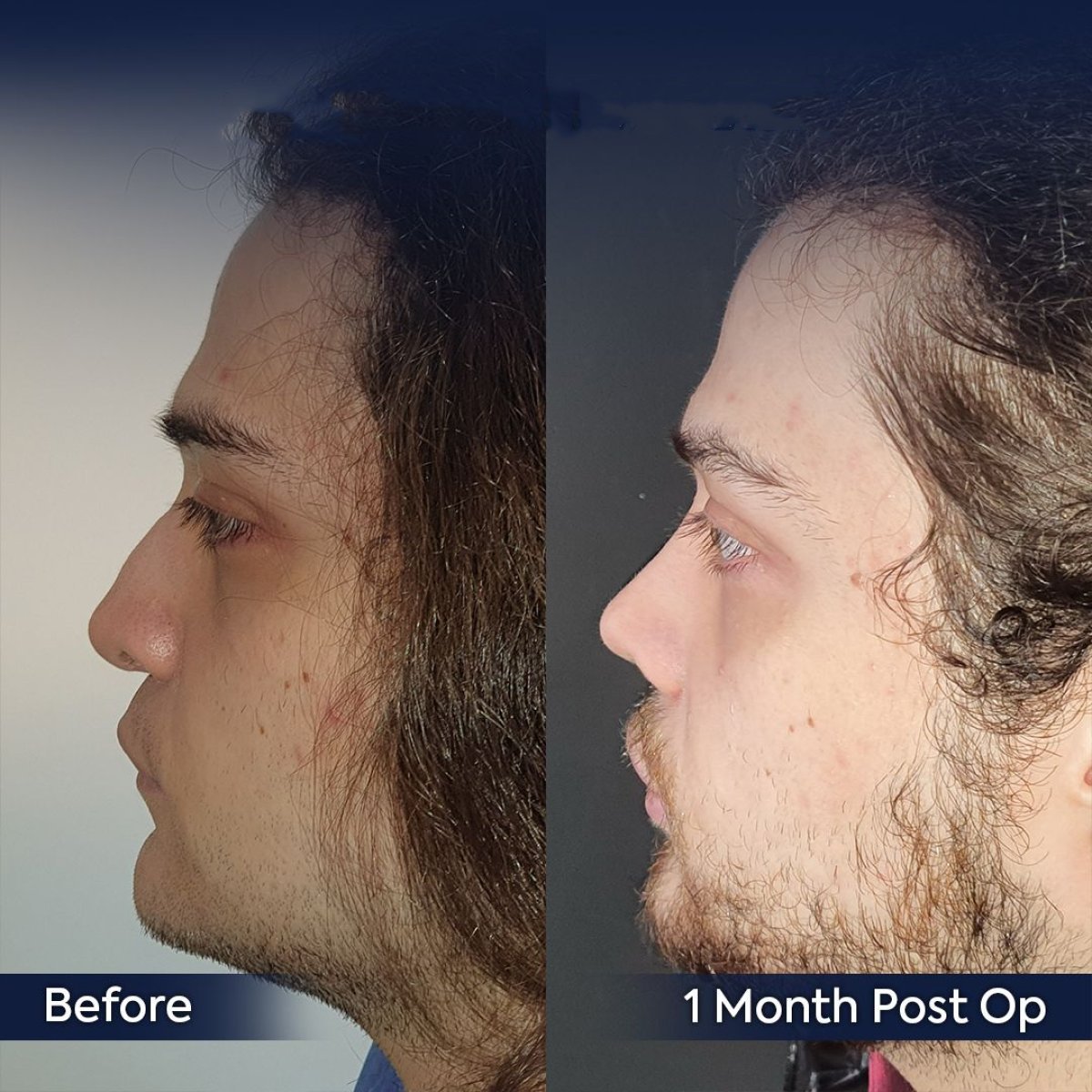 نتائج عملية تجميل الأنف قبل وبعد في عيادة Dr. Safa Manav، تحسين شكل الأنف