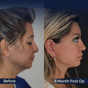 Premium Face&Neck lift + Upper Blephasroplasty+ Fat Transfer to Face Surgery -All Incluisive with European Board Certified Doctor Ali Sadioglu - photo 4