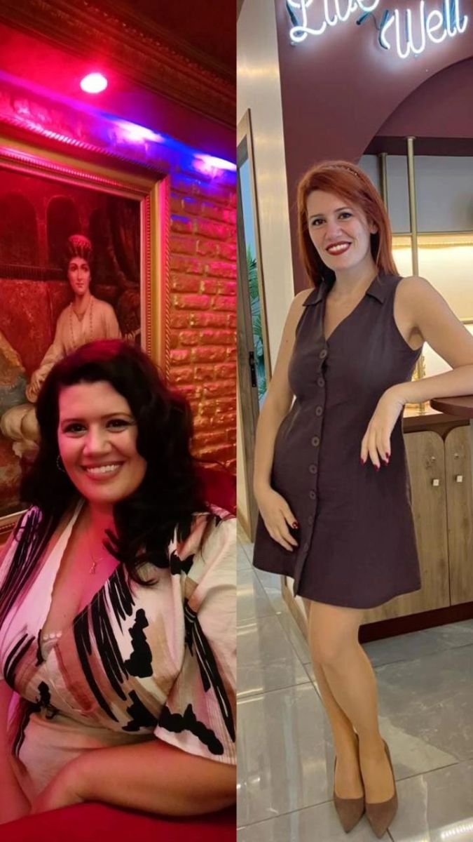 Before and after gastric sleeve surgery at Dr. MED – visible weight loss result