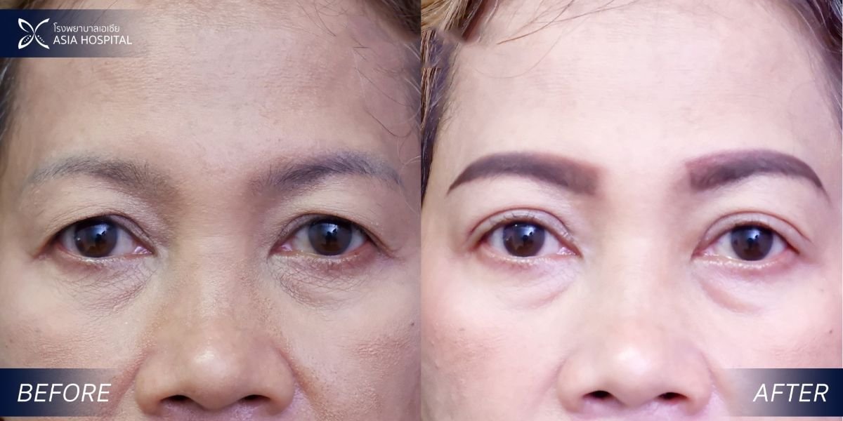 Before and after upper and lower eyelid surgery results at Asia Cosmetic Hospital, rejuvenated eyes