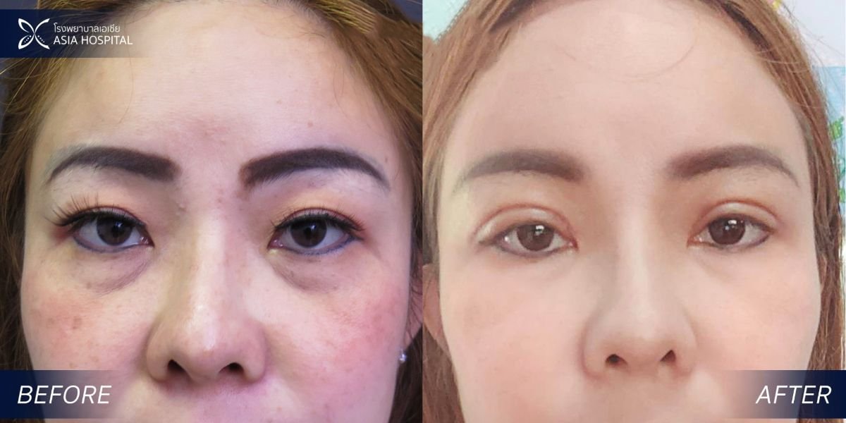 Before and after upper and lower eyelid surgery results at Asia Cosmetic Hospital, rejuvenated eyes