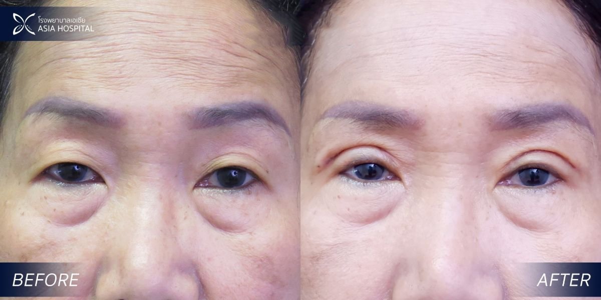 Résultats avant/après chirurgie des paupières supérieures et inférieures à Asia Cosmetic Hospital