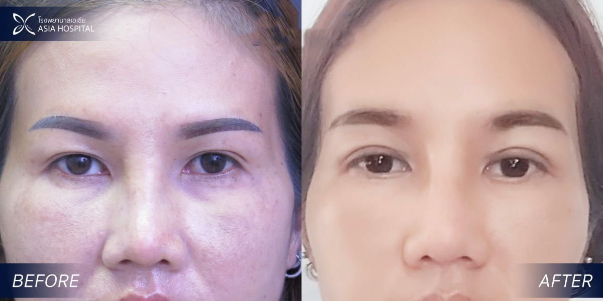 Upper and lower eyelid surgery before and after results at Asia Cosmetic Hospital, rejuvenated look