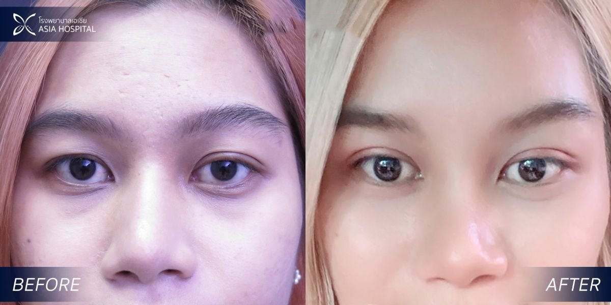 Upper and lower eyelid surgery before and after results at Asia Cosmetic Hospital, refreshed look