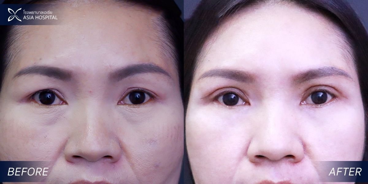 Upper and lower eyelid surgery before and after results at Asia Cosmetic Hospital, rejuvenated look