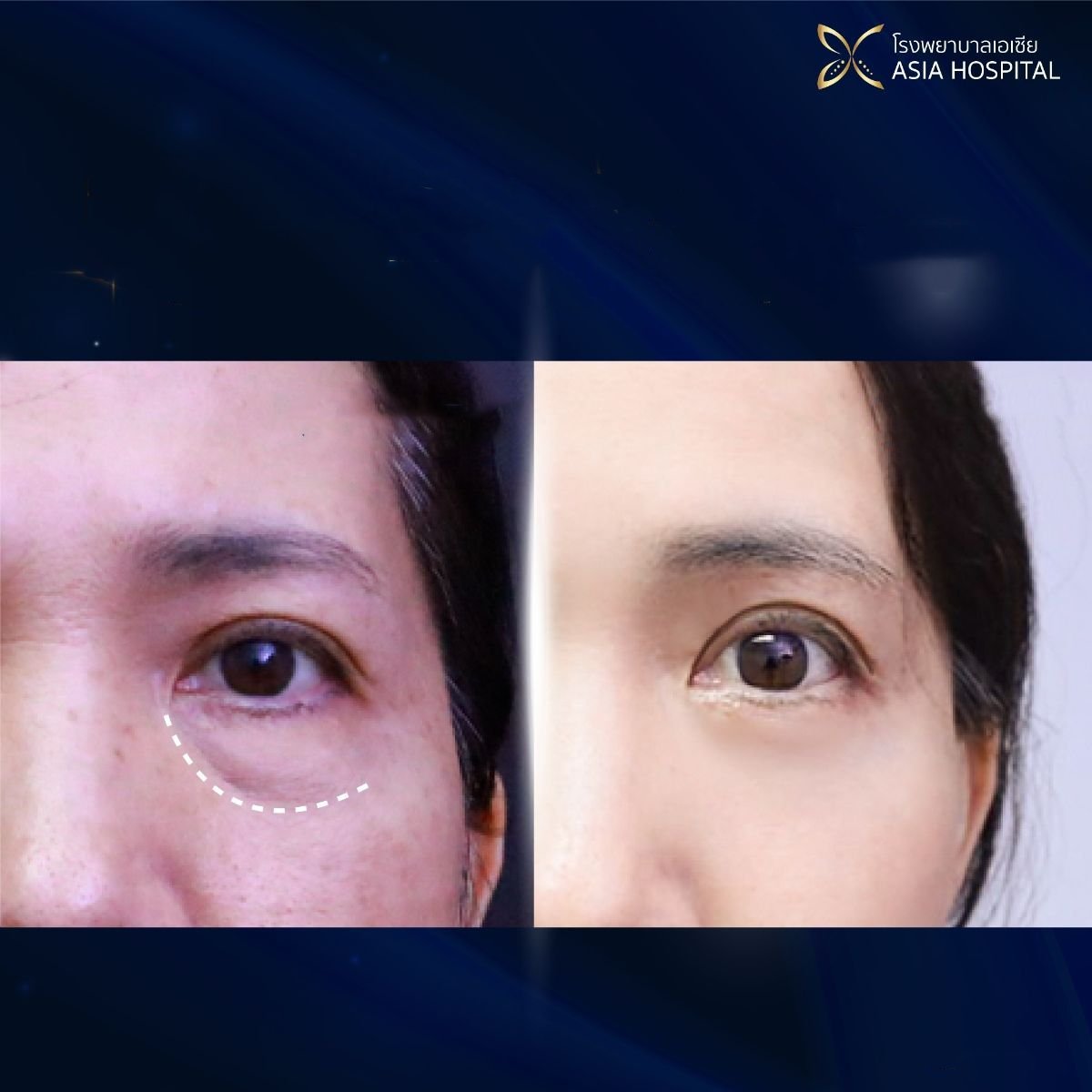 Before and after upper and lower eyelid surgery results at Asia Cosmetic Hospital