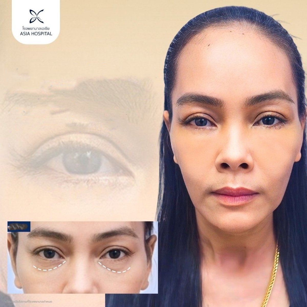 Upper and lower eyelid surgery results at Asia Cosmetic Hospital – rejuvenated eye appearance