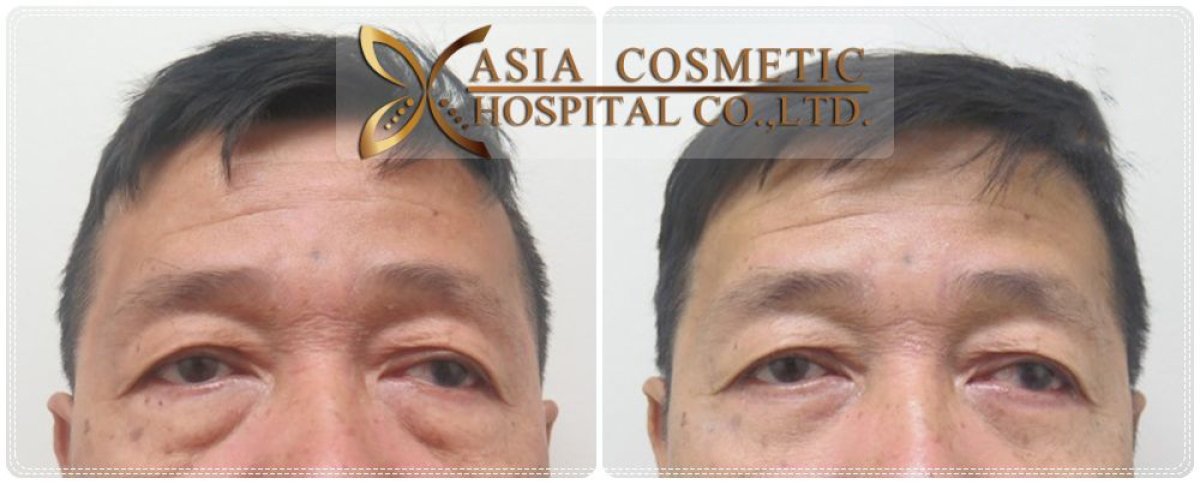 Before and after upper and lower eyelid surgery results at Asia Cosmetic Hospital, rejuvenated look