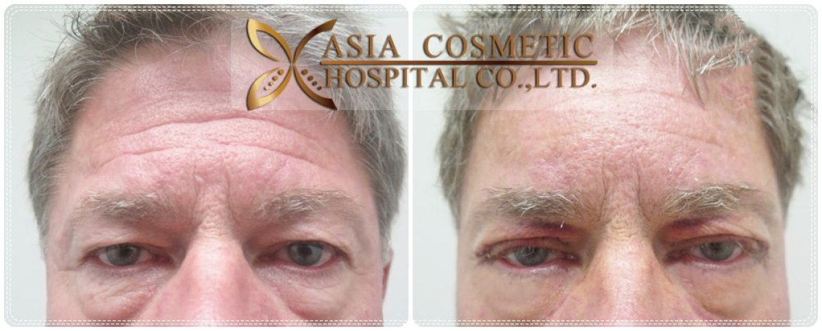 Before and after upper and lower eyelid surgery results at Asia Cosmetic Hospital