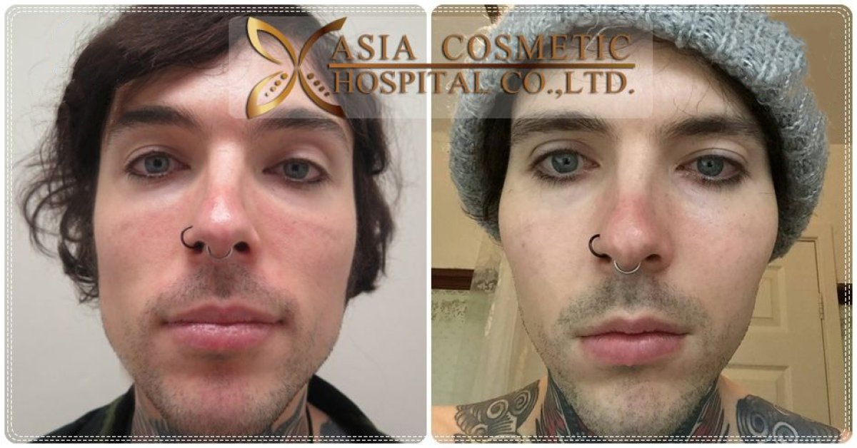 Before and after upper and lower eyelid surgery results at Asia Cosmetic Hospital