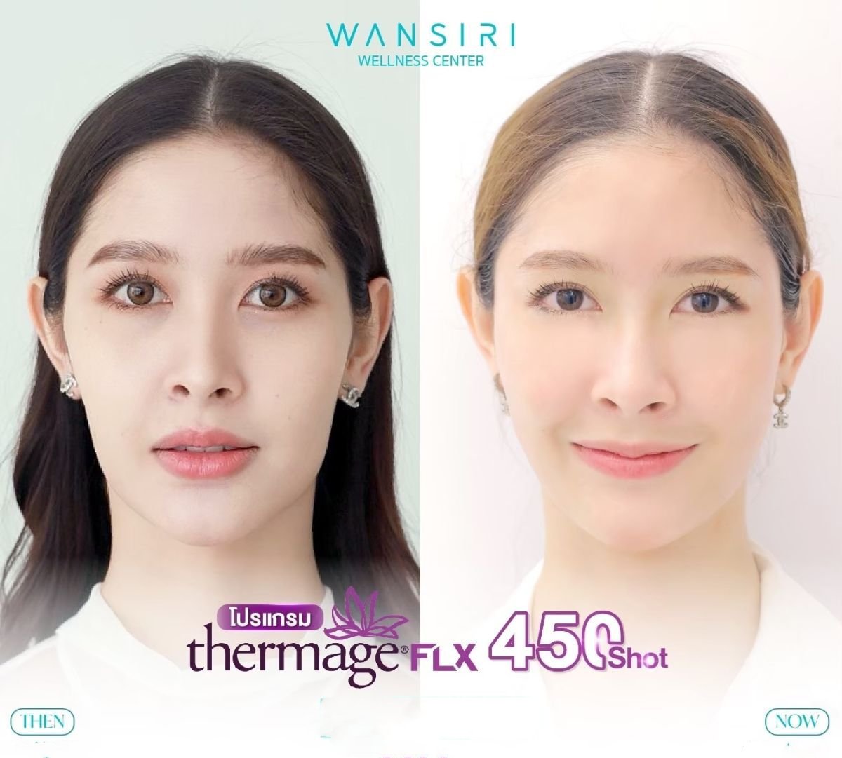 Resultados antes y después de Thermage FLX para tensado facial en Wansiri Hospital