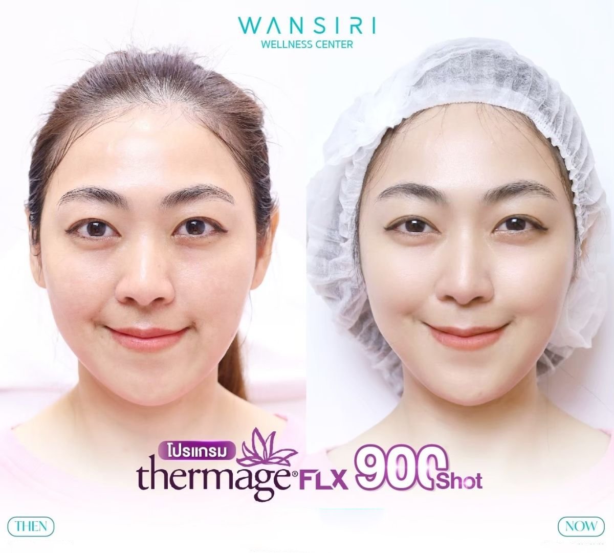 Результаты до и после Thermage FLX для подтяжки кожи лица в Wansiri Hospital