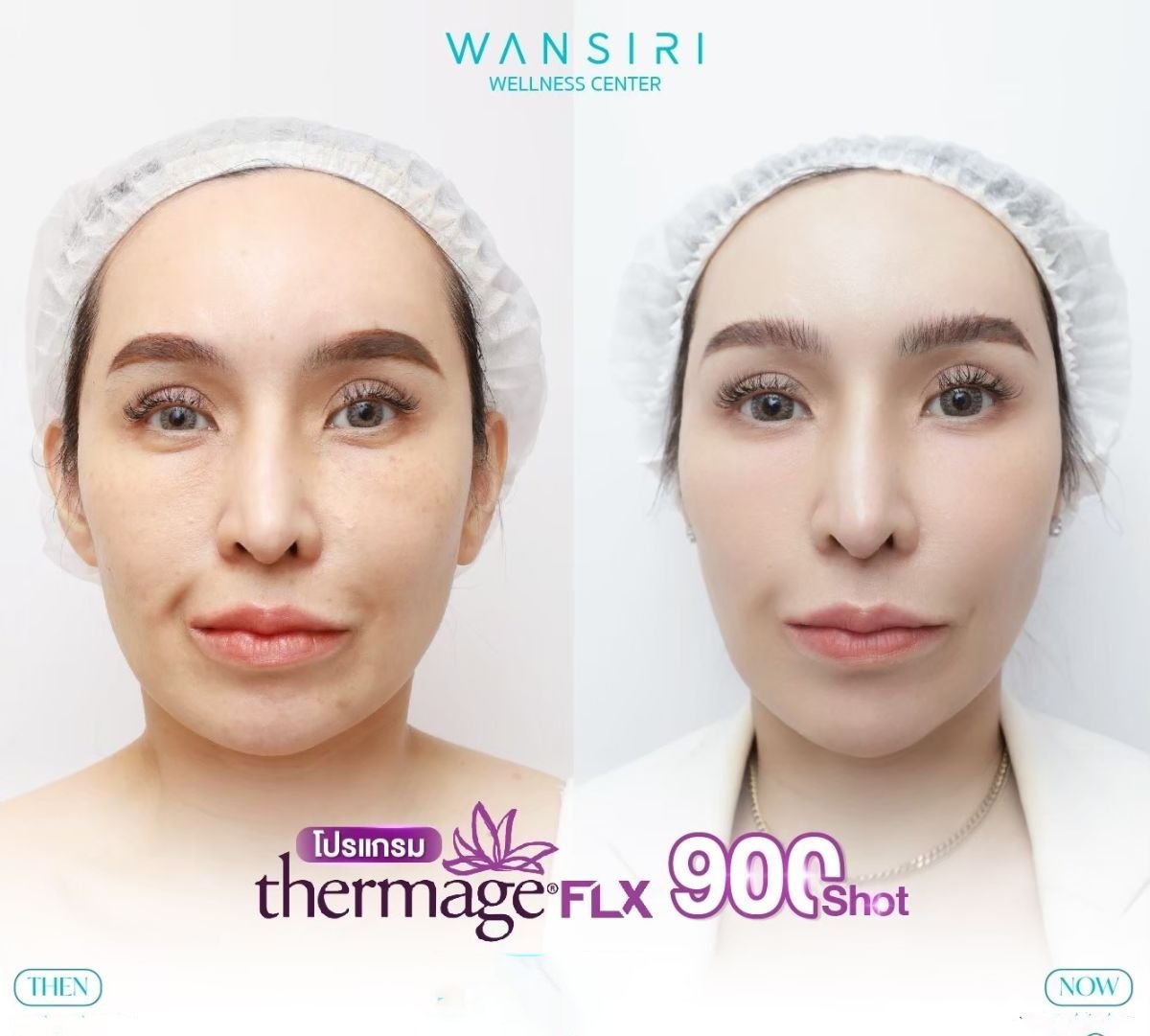 Resultados antes y después de Thermage FLX en Wansiri Hospital, reafirmación facial
