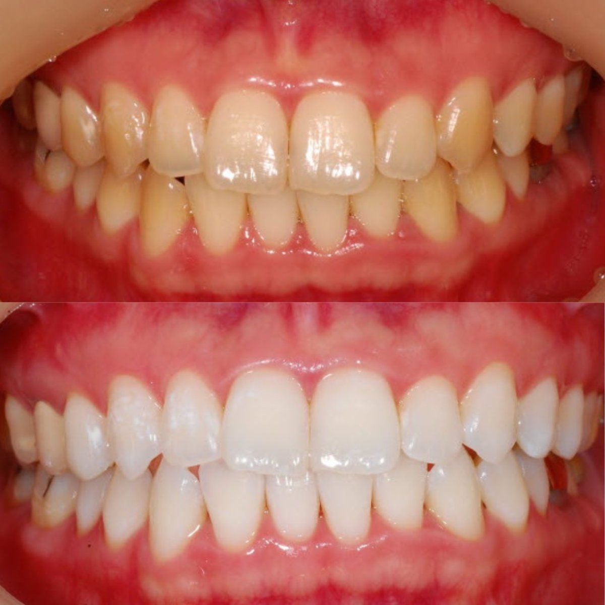 Before and after tooth whitening results at S-plant Dental Hospital, visibly brighter smile