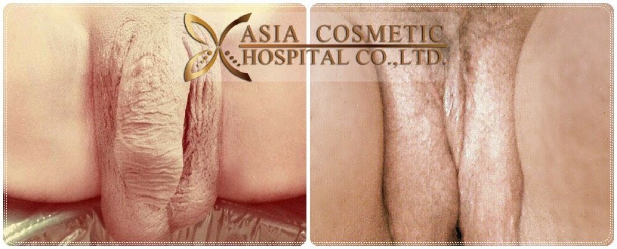 Male to female (MTF) surgery before and after results at Asia Cosmetic Hospital, genital transformation