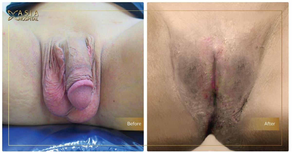 Before and after male to female (MTF) surgery results at Asia Cosmetic Hospital, genital transformation