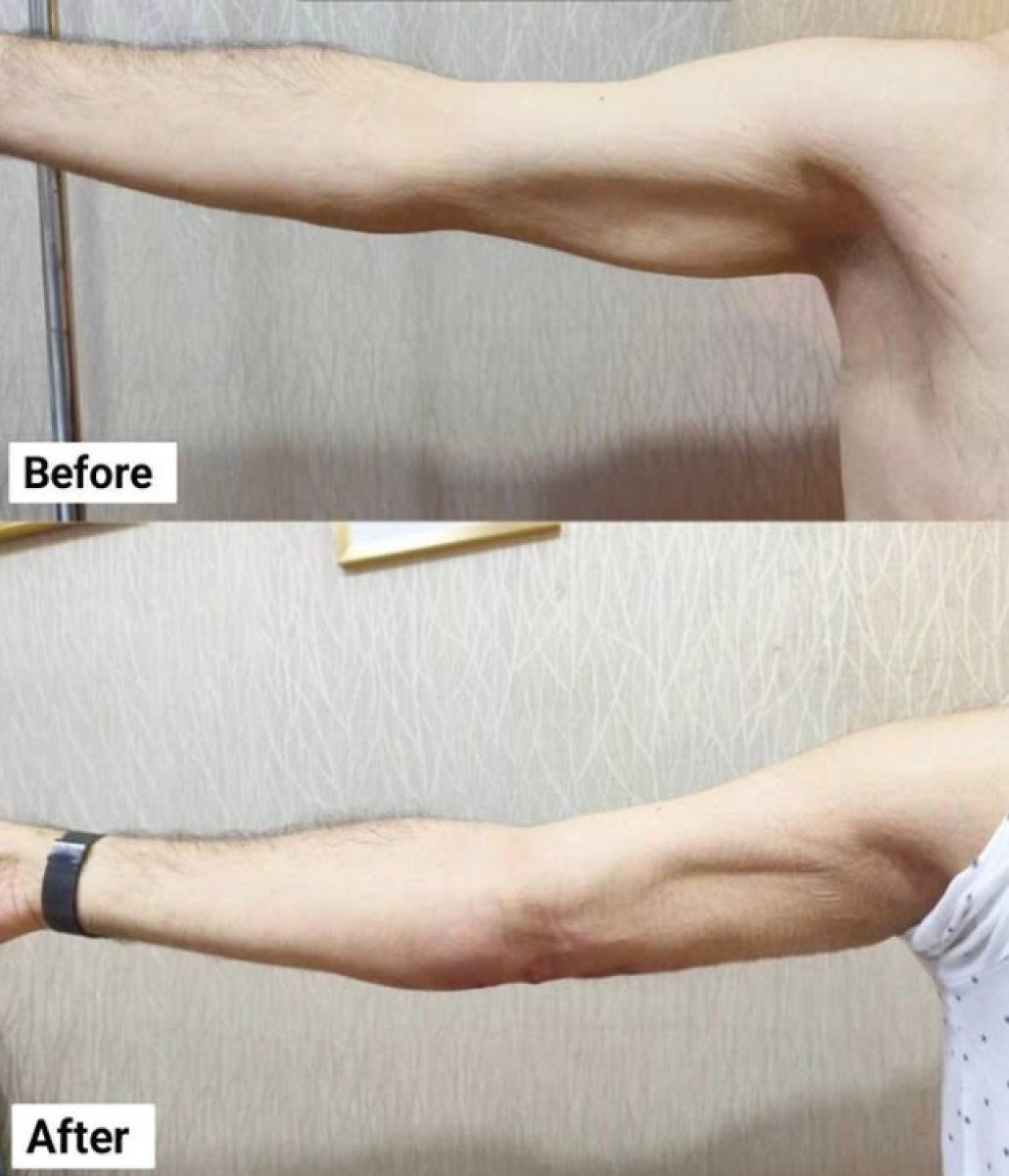 Before and after arm liposuction results at Charismma Clinic showing improved arm contour