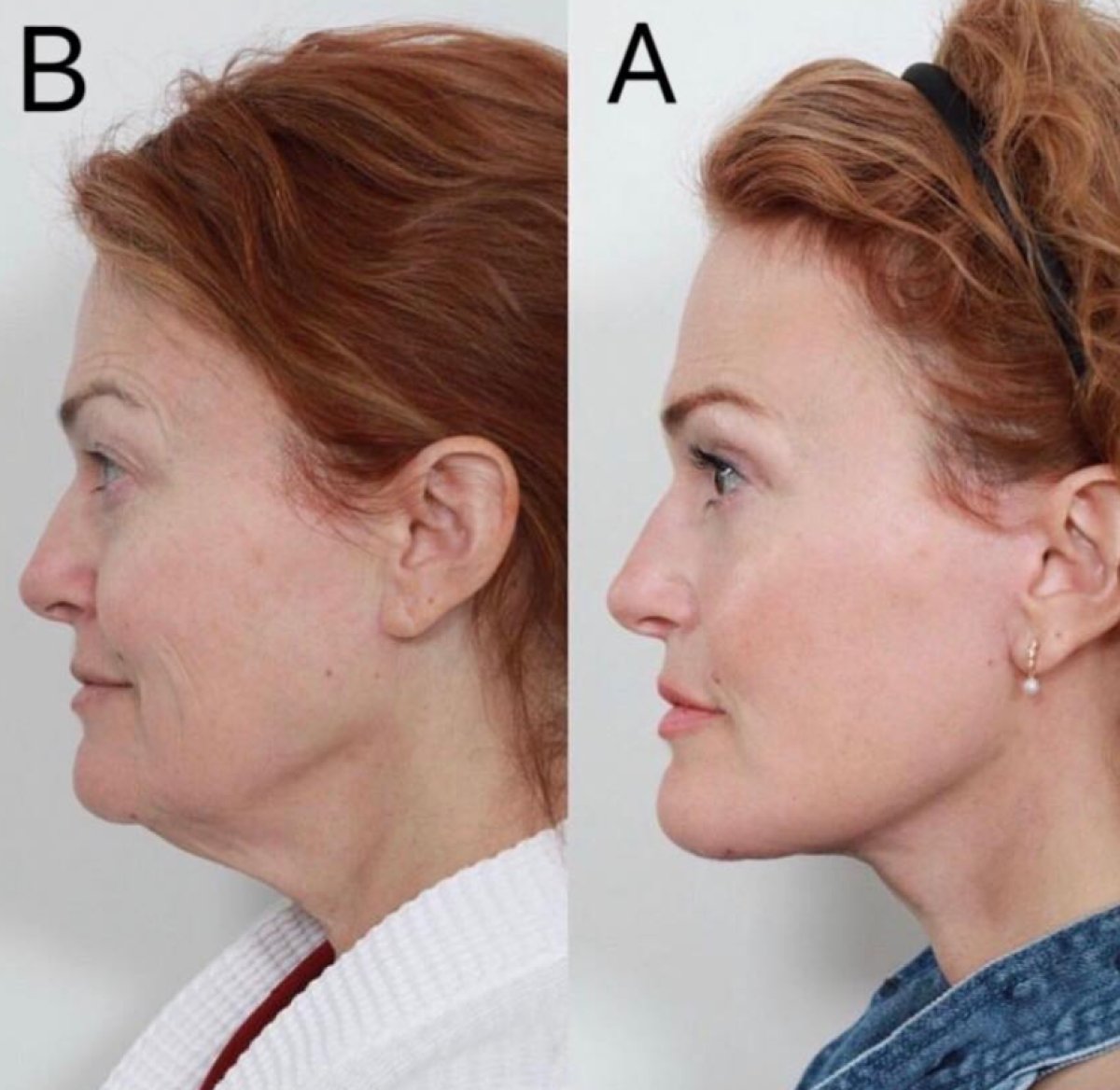 Résultats avant/après lifting du cou à Charismma Clinic, amélioration du contour du cou