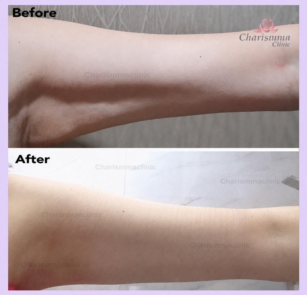Before and after arm liposuction results at Charismma Clinic, improved arm contour visible