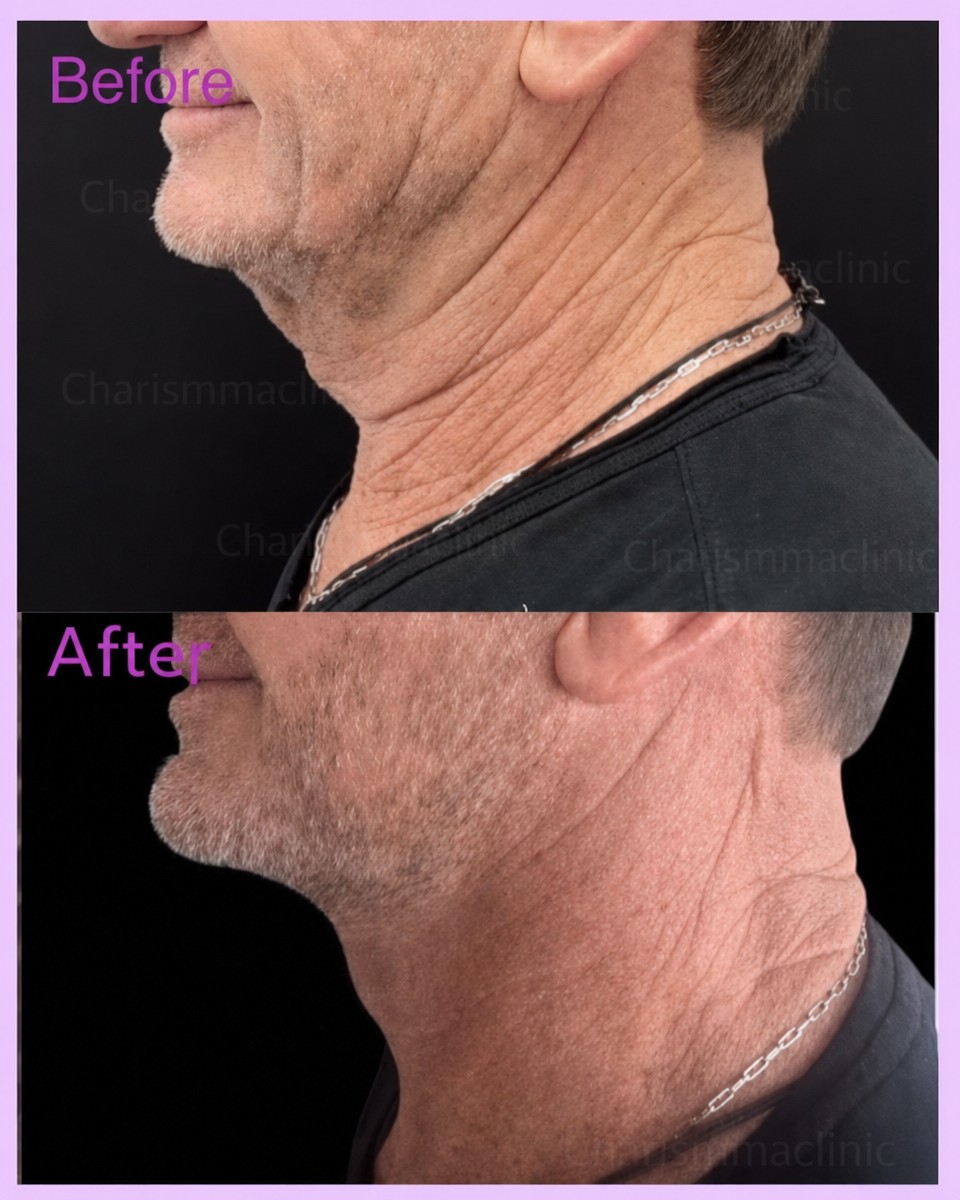 Before and after neck lift results at Charismma Clinic, improved neck contour and firmness