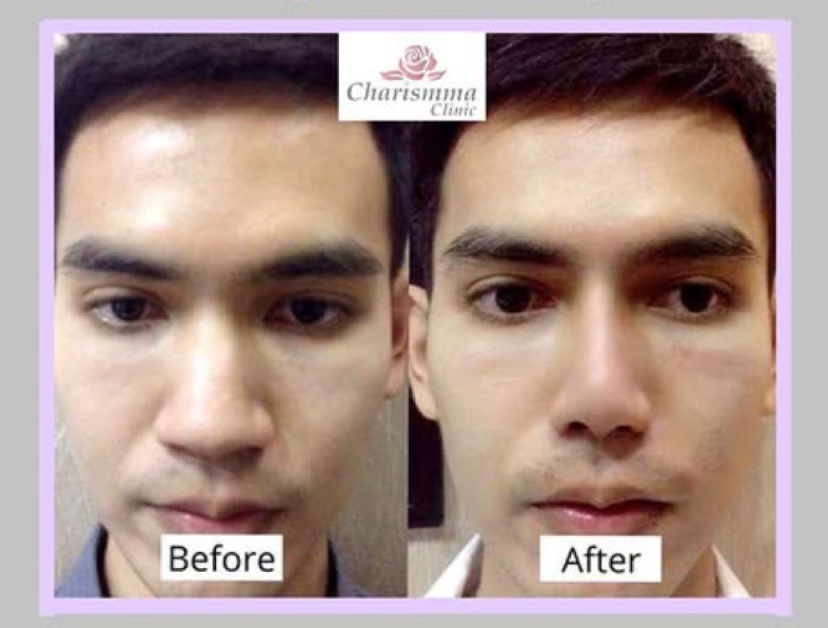 نتائج قبل وبعد عملية تصغير فتحات الأنف في Charismma Clinic، تحسين شكل الأنف وتناسقه