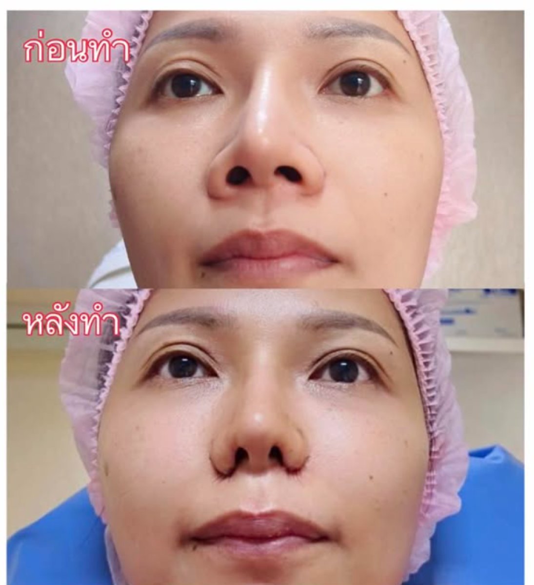نتائج قبل وبعد عملية تصغير فتحات الأنف في Charismma Clinic، تحسين شكل الأنف