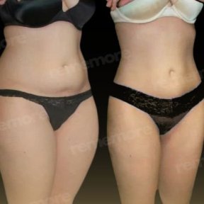 Standard 360 Liposuction with All Included - photo 2