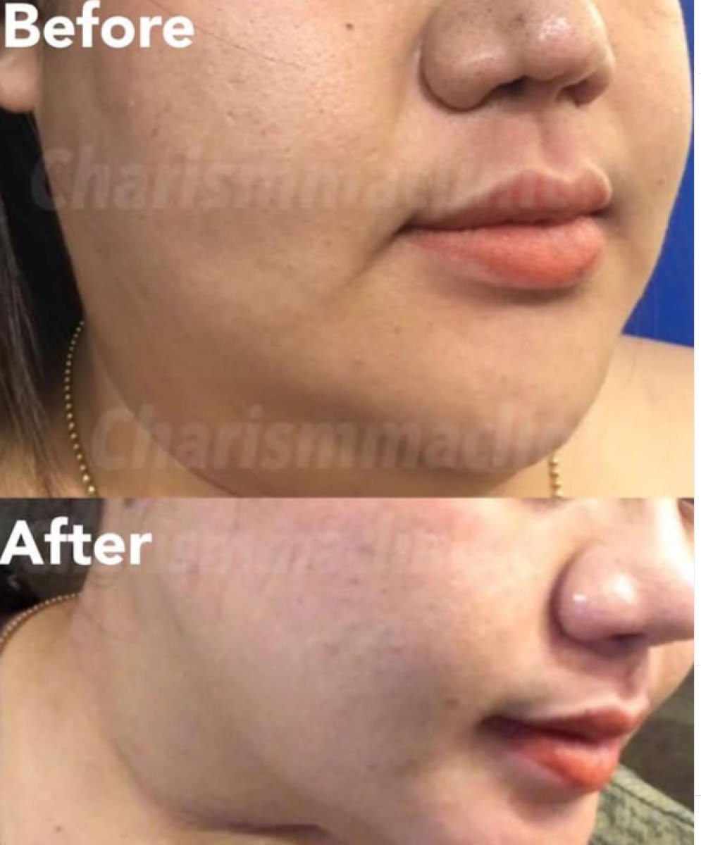 نتائج شفط دهون الذقن قبل وبعد في Charismma Clinic، تحديد الفك المحسن
