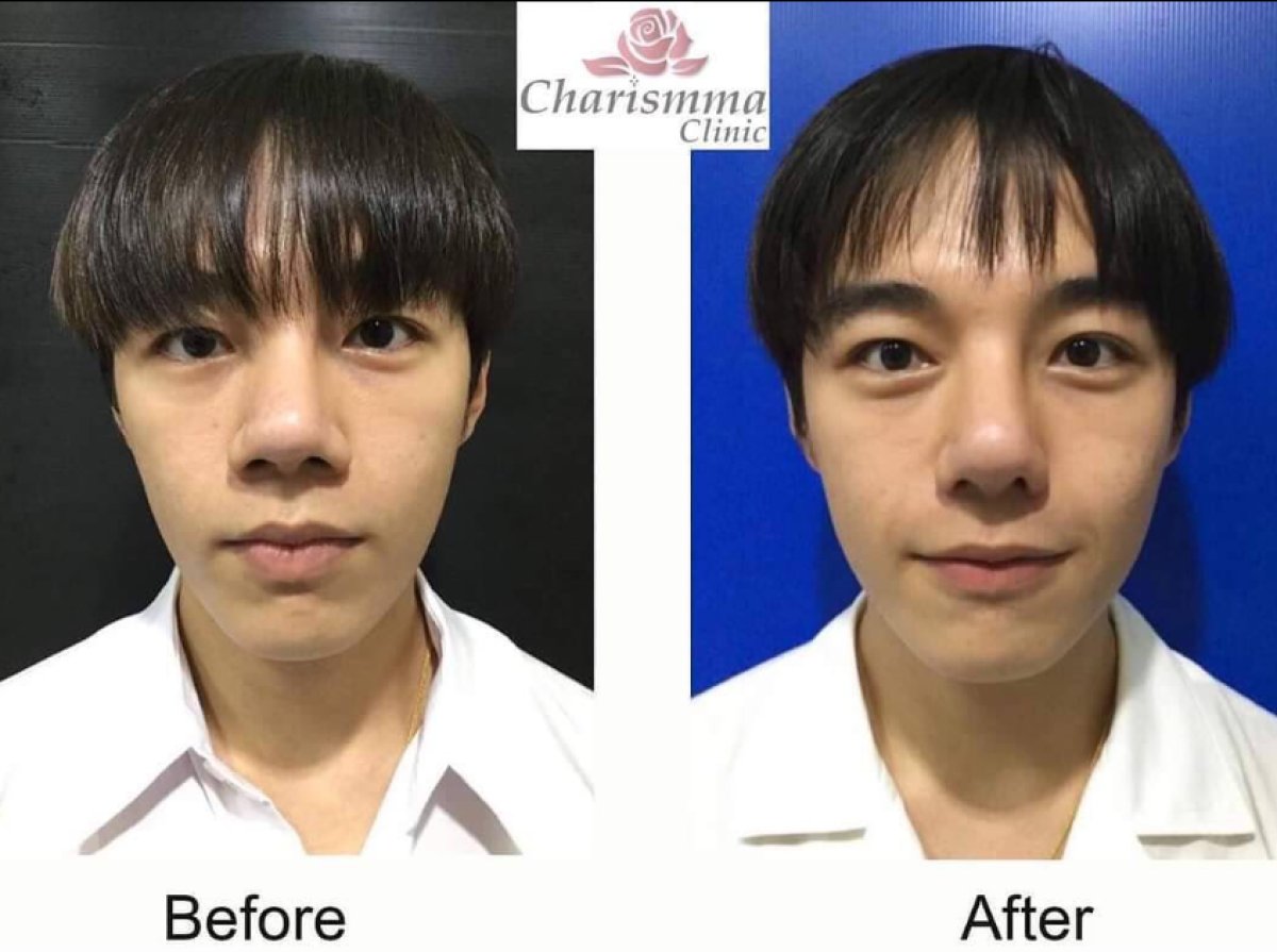 نتائج قبل وبعد عملية تصغير فتحات الأنف في Charismma Clinic، تحسين شكل الأنف