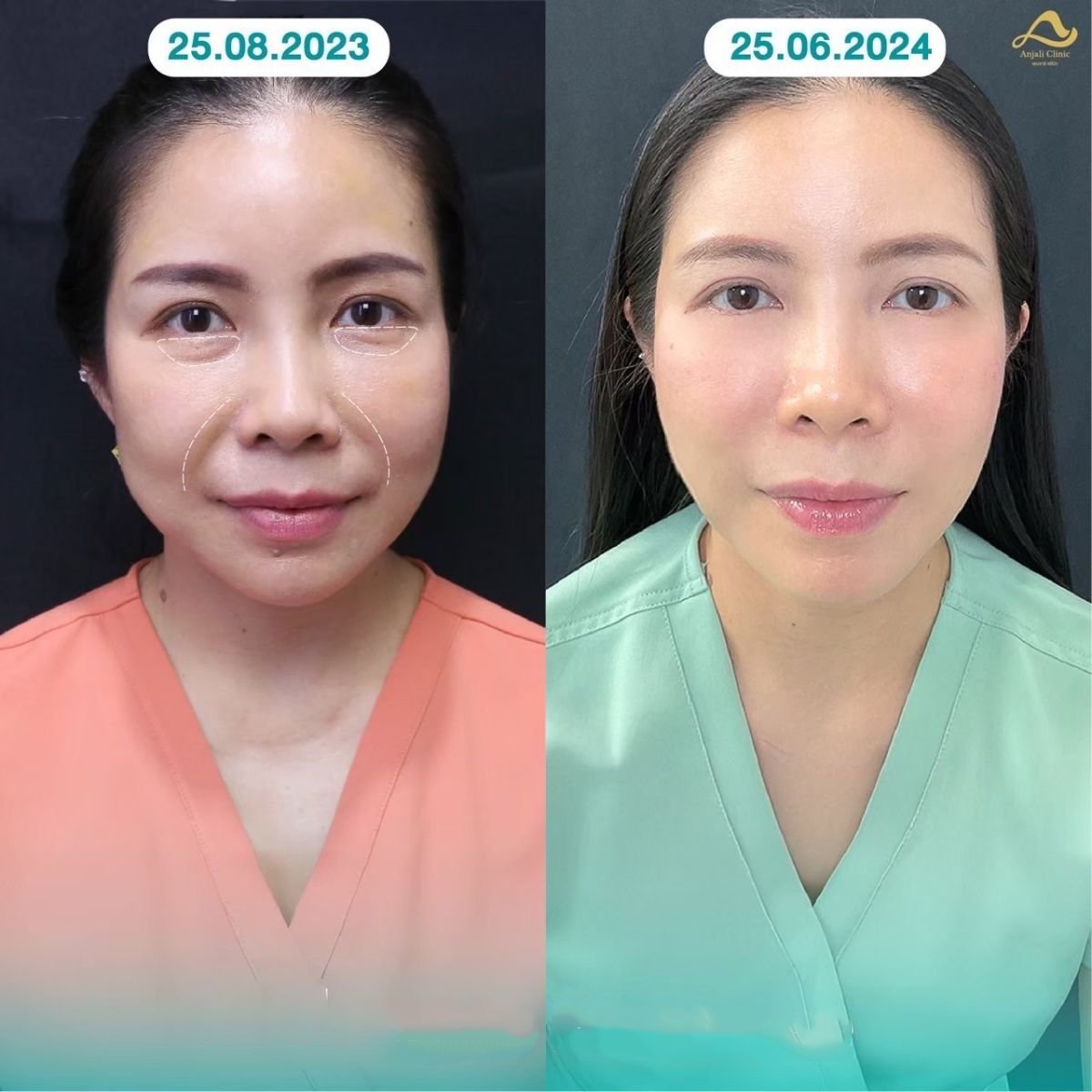 Before and after nonsurgical facelift results at Anjali Clinic – visible facial rejuvenation