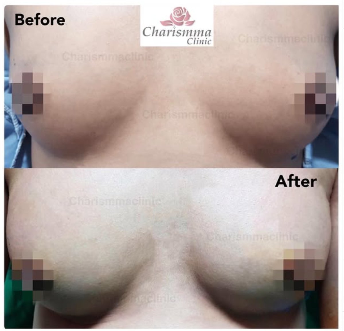 Resultados antes y después de aumento de senos con transferencia de grasa en Charismma Clinic