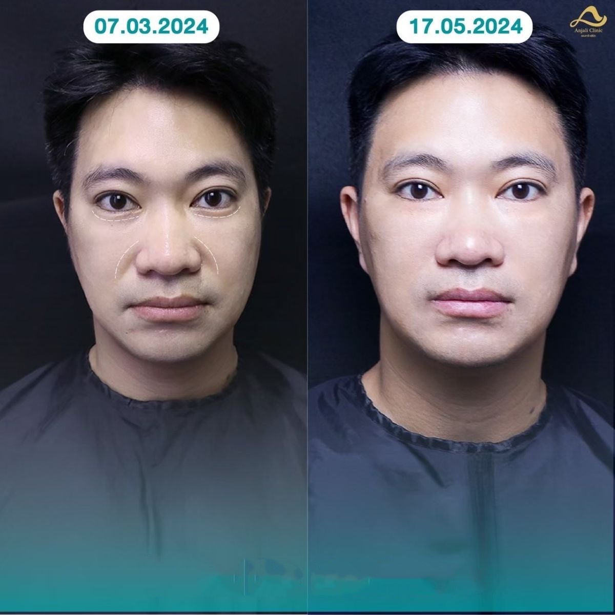 Before and after nonsurgical facelift results at Anjali Clinic, visible facial rejuvenation