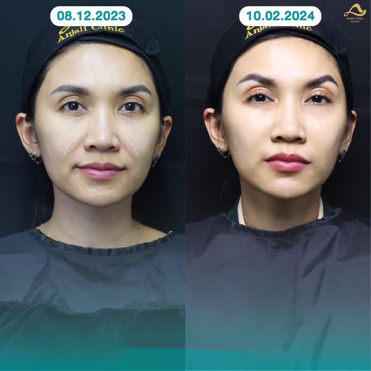 Before and after nonsurgical facelift results at Anjali Clinic – facial rejuvenation visible