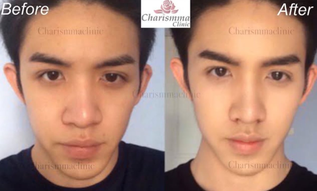 نتائج تصغير فتحات الأنف قبل وبعد في Charismma Clinic، تحسين واضح لشكل الأنف