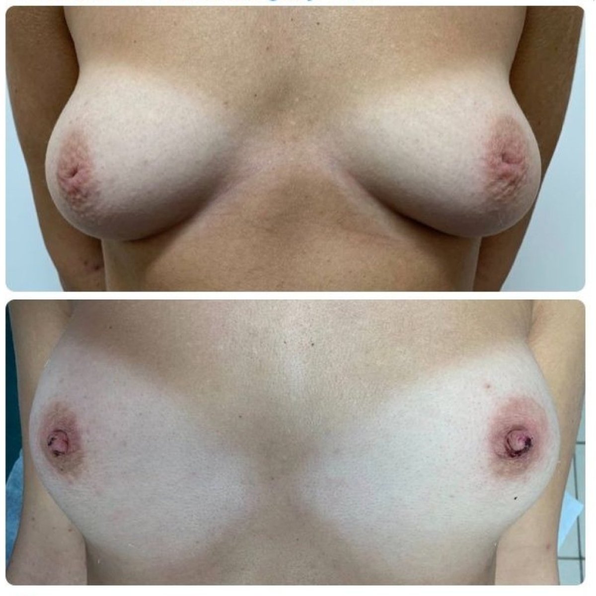 Before and after nipple correction results at Yurchenko Plastic Surgery Team Kyiv, improved shape