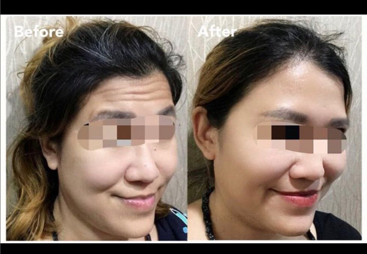 قبل وبعد حقن البوتوكس في Charismma Clinic، نتيجة جبين ووجه أكثر نعومة