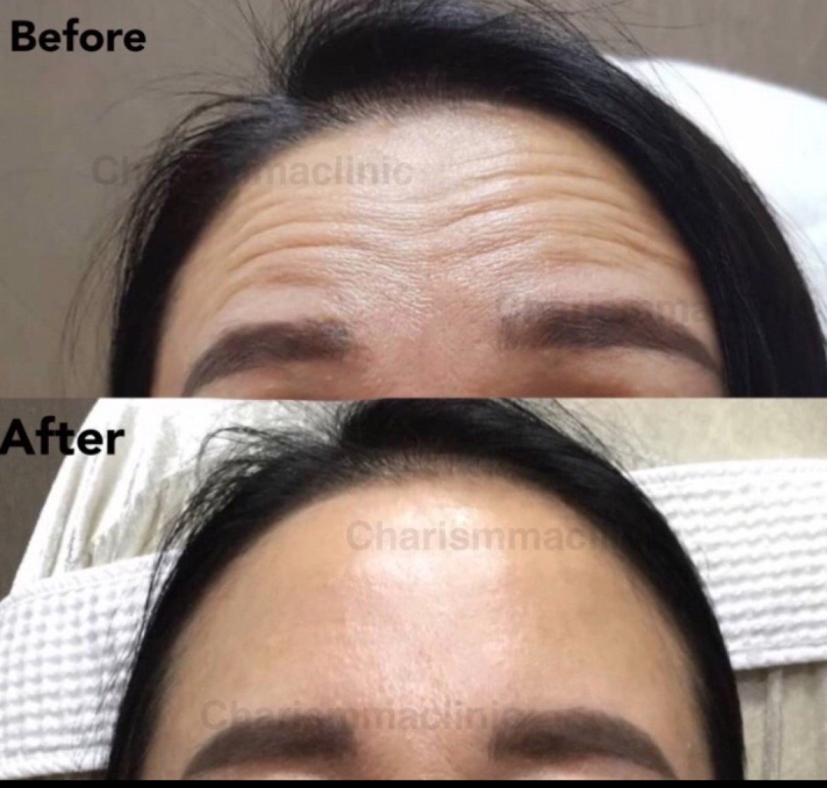 До и после инъекций ботокса в Charismma Clinic, результат разглаживания лба