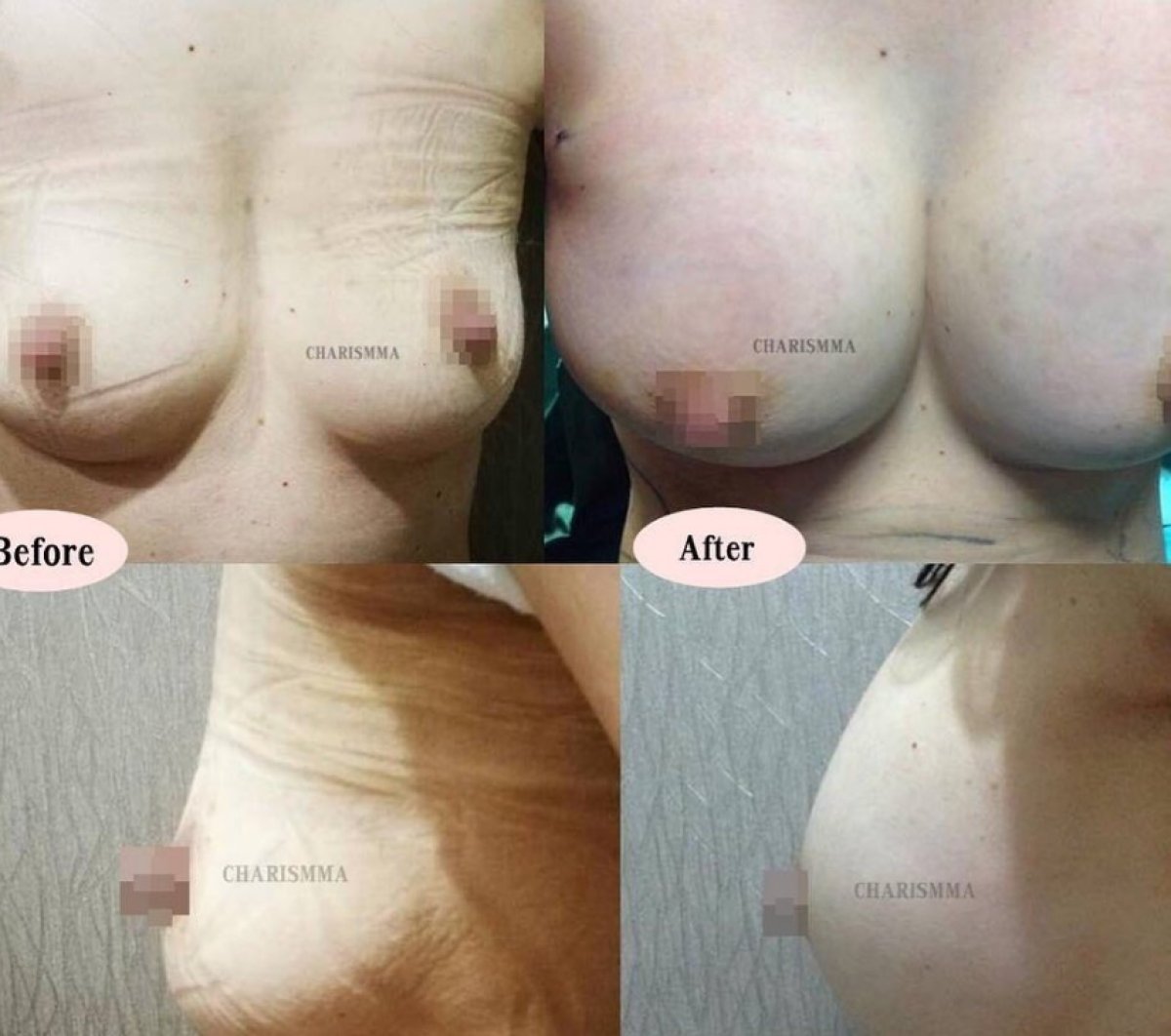 نتائج قبل وبعد تكبير الثدي في Charismma Clinic، زيادة حجم الثدي