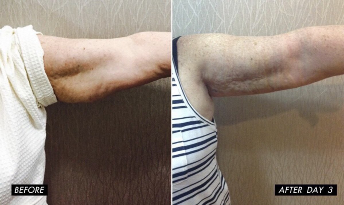Resultados de liposucción de brazos antes y después en Charismma Clinic, mejora visible